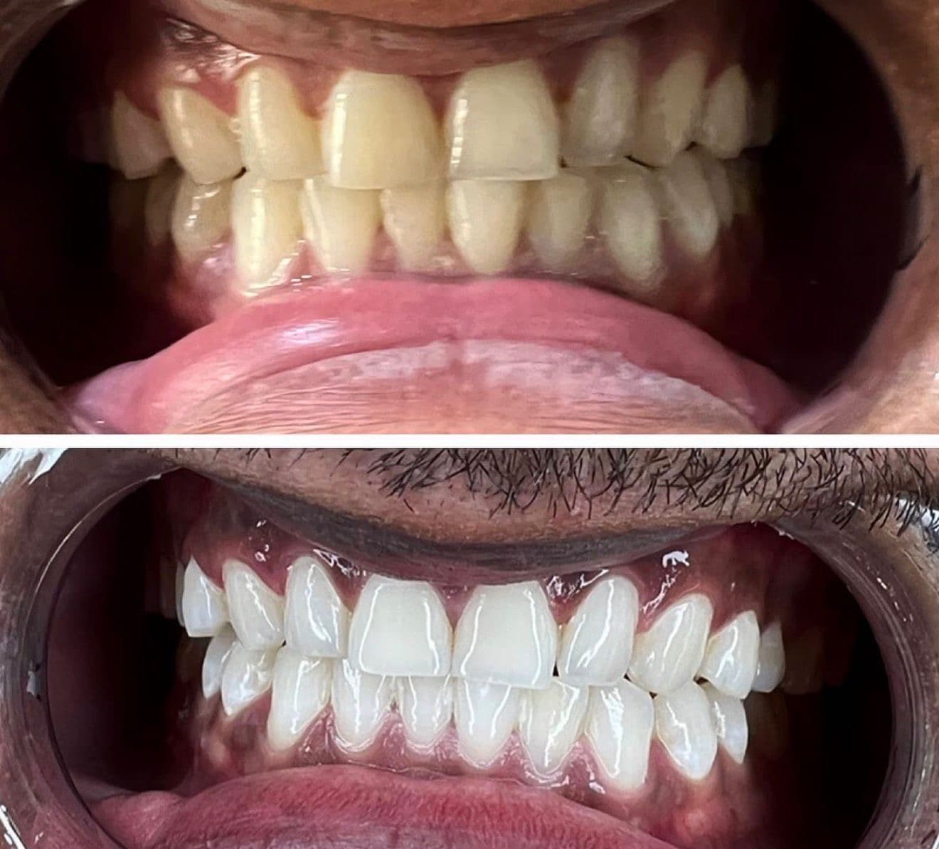 Teeth whitening before and after 1