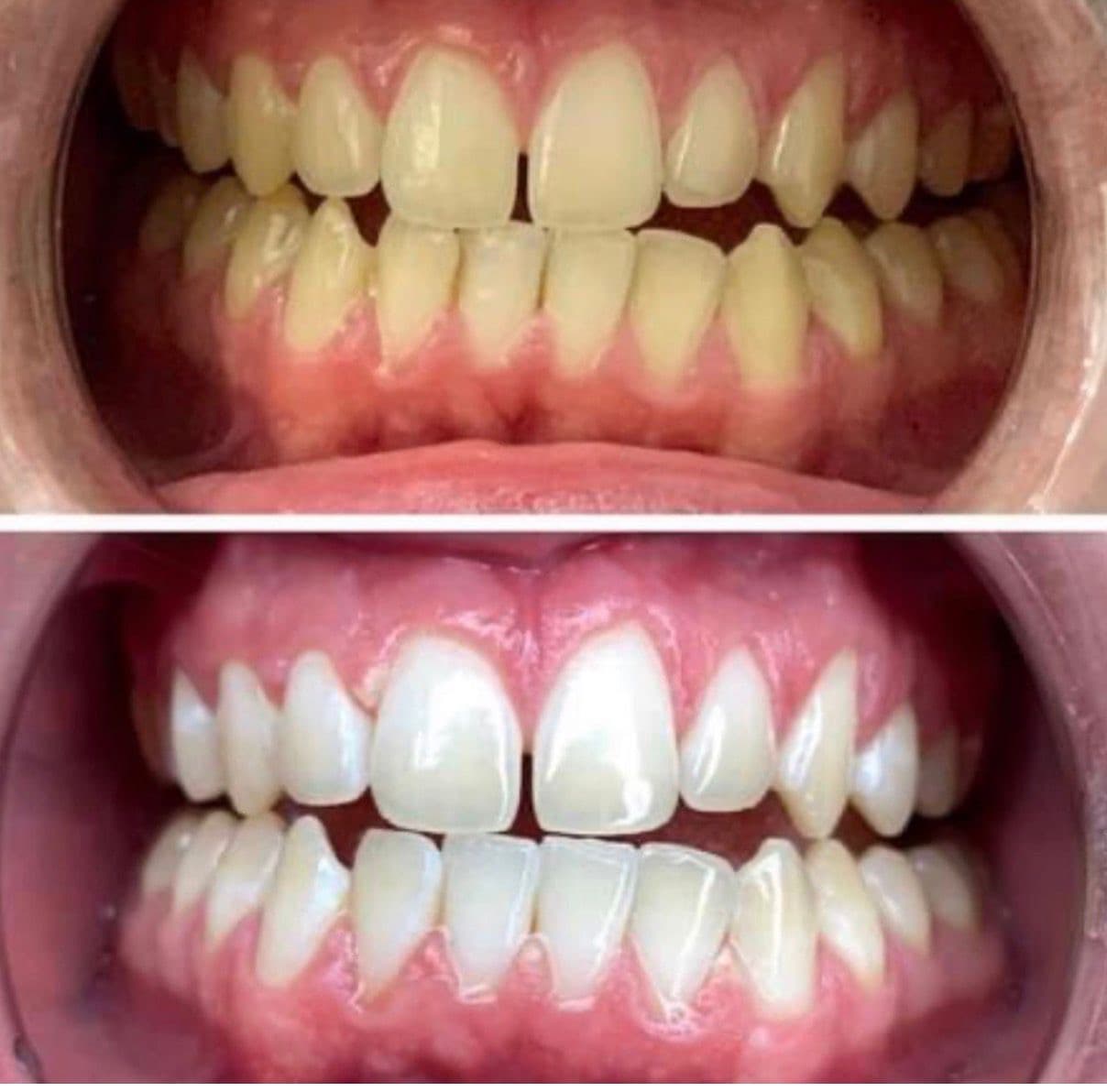 Teeth whitening before and after 2