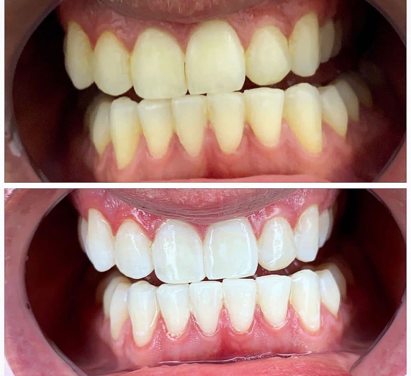 Teeth whitening before and after 4